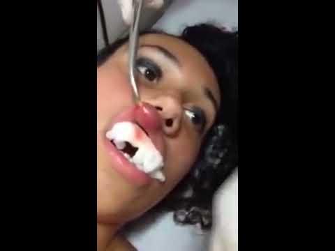 Imagini şocante: Medicii au scos un vierme viu din buza unei femei! Filmuleţul a fost văzut de peste un milion de oameni