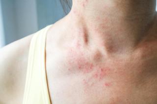 Cum să tratezi eczemele care apar în sezonul rece