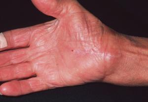 O femeie avea furnicături la mâini și picioare și a crezut inițial că e vorba doar despre un siptom banal. Ce diagnostic a primit