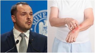 S-a confirmat primul caz de lepră în România după 44 de ani! Încă 3 suspiciuni se aplică în cazul unor maseuze asiatice din Cluj