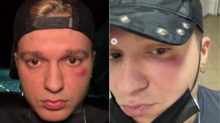 Influencerul Louis Florea, de urgență la spital, după ce s-a trezit cu o umflătură pe față. Ce au descoperit medicii