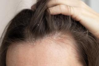 Scalp uscat vs. mătreață: care este diferența? Cum remediezi scalpul urcat