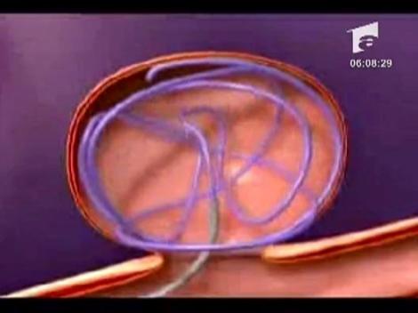 Operatie pe creier la un bebelus de 4  luni