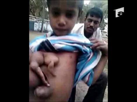 Un baiat de 7 ani s-a nascut cu 4 maini si 4 picioare