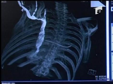 Premiera medicala la Targu-Mures