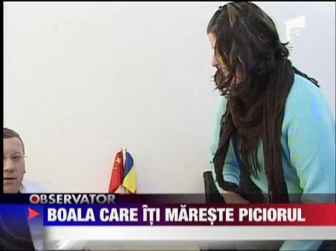 Acromegalia, boala care iti mareste piciorul