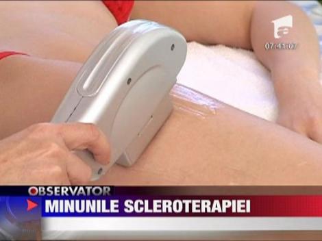 Felicia: Sedinta de scleroterapie