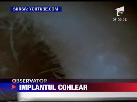 Sanatate: Implantul cohlear