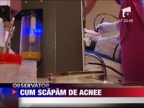 Cum scapam de acnee
