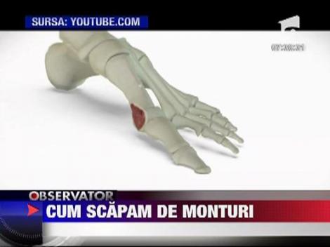 Sanatate: Cum scapam de monturi