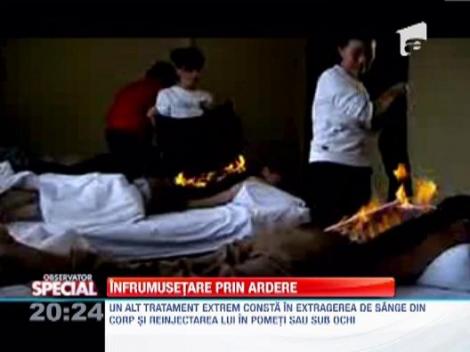 Tratamentul facial cu foc, ultimul trend in materie de infrumusetare!