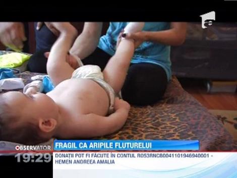 Boala copilul fluture: risca sa moara daca o atinge cineva