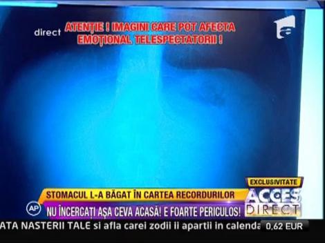 "Omul cu stomacul de cauciuc", la radiografie