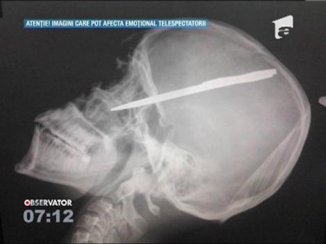 Un tanar din Bucuresti a ajuns la spital cu o sabie infipta in craniu