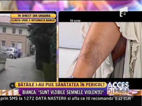 Bianca, despre dramele cu Coco Paun: "Sunt vizibile semnele violentei"