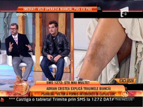 Dr. Dobos: "Bianca Dragusanu putea scapa de vanatai cu laser"