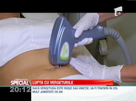 Tratamentul pe bază radio-frecvenţă împotriva vergeturilor