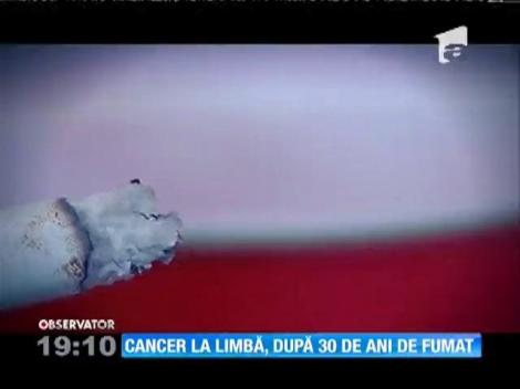 UPDATE / Cancer la limbă, după 30 de ani de fumat