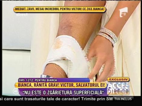 IMAGINI ȘOCANTE! Bianca Drăgușanu, la scurt timp după accidentare: Iată cum arată rana vedetei!