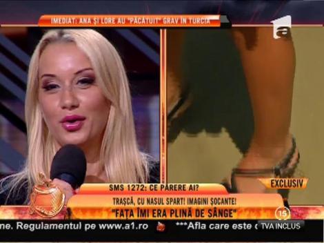 Simona Traşcă și-a spart nasul în vacanță din Delta Dunării