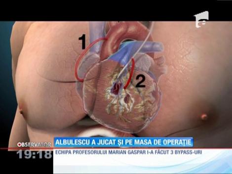 UPDATE/ Actorul Mircea Albulescu a fost operat pe cord