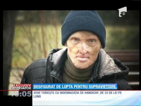 Un clujean desfigurat de o explozie, discriminat de angajatori