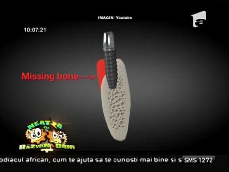 Bună dimineaţa, sănătate! Despre adițiile de os în cazul unui implant dentar