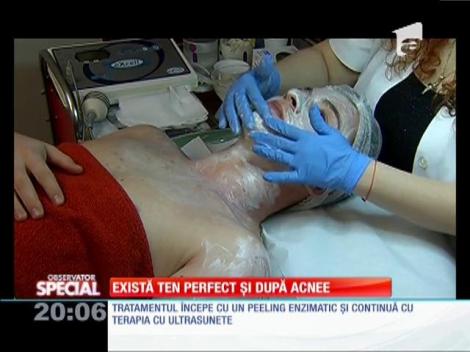 SPECIAL! Există ten perfect şi după acnee