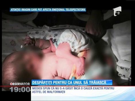 S-au născut lipiţi unul de altul! Iar mama lor &icirc;l va str&acirc;nge doar pe unul &icirc;n braţe