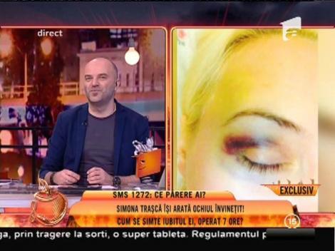 Simonei Traşcă i-a coborât cucuiul de pe frunte sub ochi!