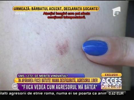 Tatiana, mama mutilată pentru că a sărit să-și apere copilul: "Fiica vedea cum agresorul mă bătea"