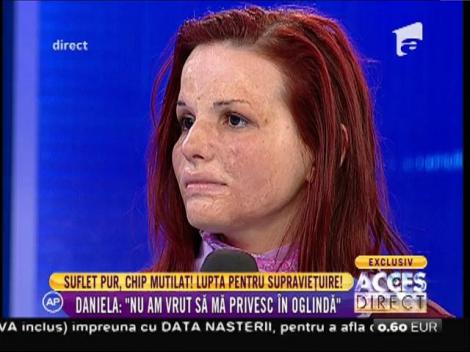 Povestea Danielei Băloi, o tânără mutilată de o explozie, la "Dreptul la fericire"!