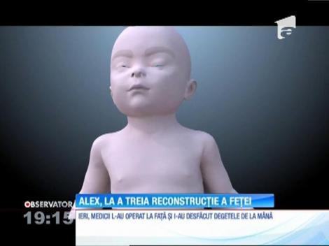 Alex, băiatul de patru ani mutilat de o explozie, la a treia reconstrucţie a feţei