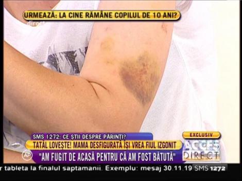 Tatiana Voicu, mama lui Alex, plină de vânătăi: "Am fugit de acasă pentru că am fost bătută!"