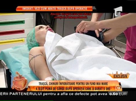 Simona Traşcă, chinuri înfiorătoare pentru un posterior mai mare. Operația a durat 5 ore!