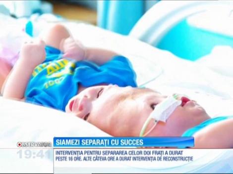 Siamezi uniți în zona capului, despărțiți cu o operaţie extrem de delicată
