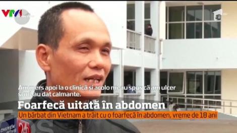 Un bărbat din Vietnam a trăit cu o foarfecă în abdomen, vreme de 18 ani