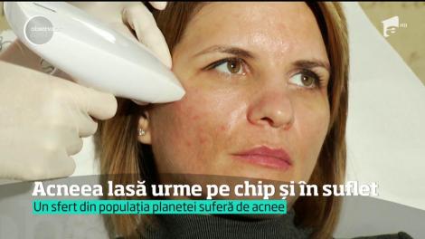 Acneea lasă urme pe chip și suflet. Un sfert din populația planetei suferă de această afecțiune