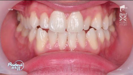 De ce este important să îndreptăm dinţii la copii?