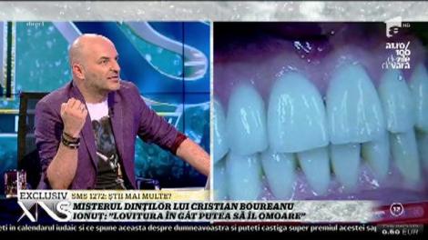 Stomatologul lui Cristian Boureanu: ”Are șapte dinți afectați, iar unul dintre ei este retezat de la nivelul gingiei”