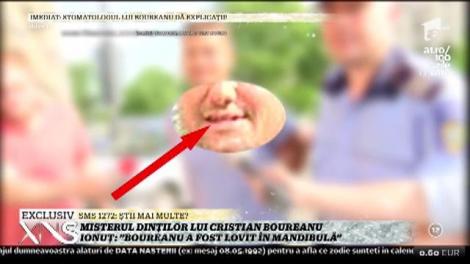 Misterul dinţilor distruşi ai lui Boureanu se adânceşte! Martor: ”Nu avea nicio umflătură, niciun plasture”