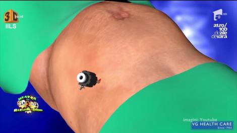 Bună dimineața, sănătate! Apendicita nu apare doar la copii! Care sunt cauzele, simptomele, dar și cum se poate trata pentru a evita complicațiile