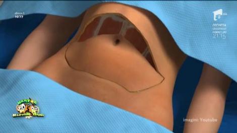 Reconstrucția sânului după mastectomie