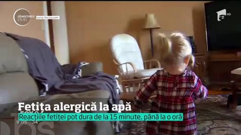 O fetiţă se confruntă cu una dintre cele mai grele alergii din lume: nu se poate atinge de apă! Și dacă pl&acirc;nge, pielea devine o rană deschisă