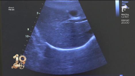 Bună dimineața, Sănătate! Totul despre hepatita A, B și C. Simptome si tratament