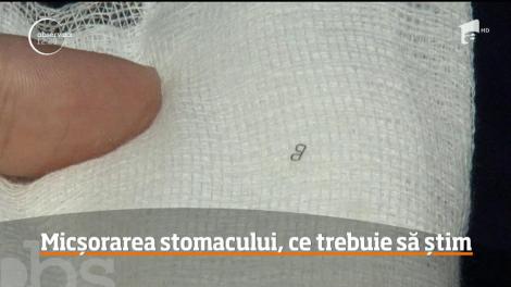 Operaţiile chirugicale de micşorare a stomacului sau inelele gastrice sunt soluţii împotriva grăsimii în exces