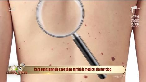 Alunițele de pe piele pot indica un cancer cutanat! Acestea sunt semnele ce te trimit de urgență la dermatolog!