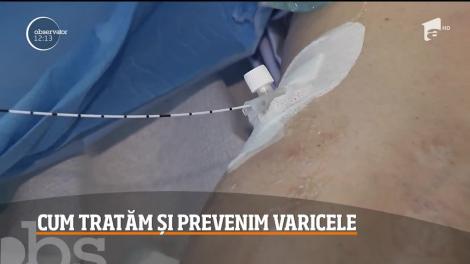 Cum tratăm și prevenim varicele? Ce sfaturi ne dau specialiștii