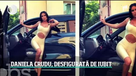 Daniela Crudu a fost desfigurată de iubit. Într-o criză de gelozie, croatul a lovit-o cu bestialitate pe fosta asistentă