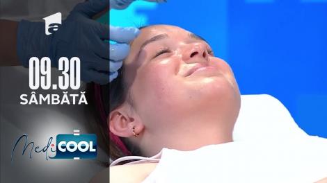 Medicool sezonul 1, 16 octombrie 2021. Ce este peelingul chimic